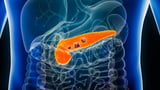 AI detects “invisible” signs of pancreatic cancer years before diagnosis
